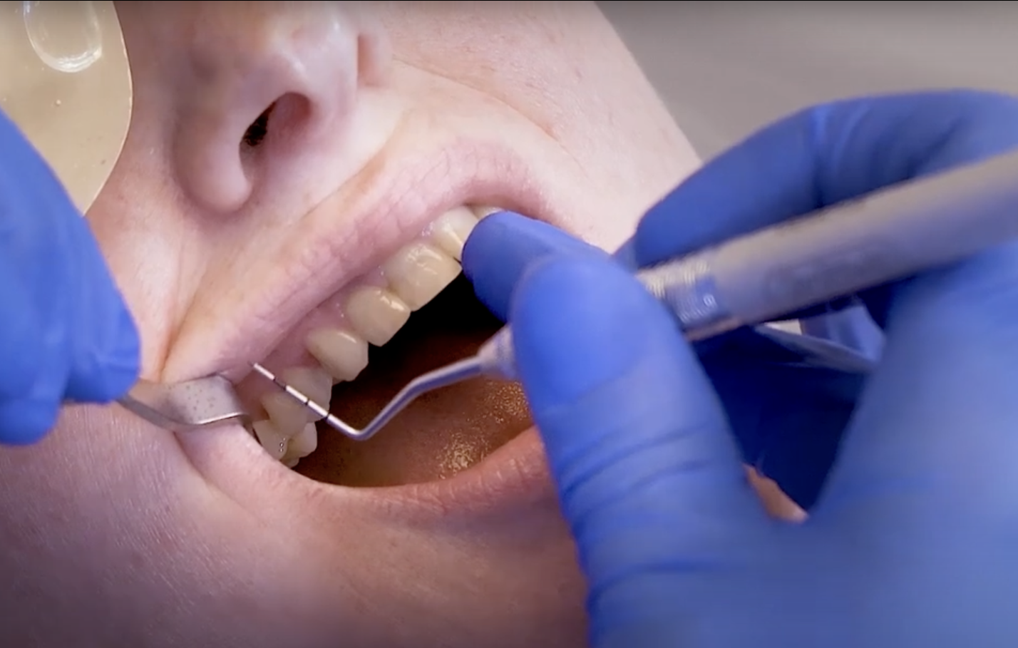 PSI Erhebung mit der WHO Sonde