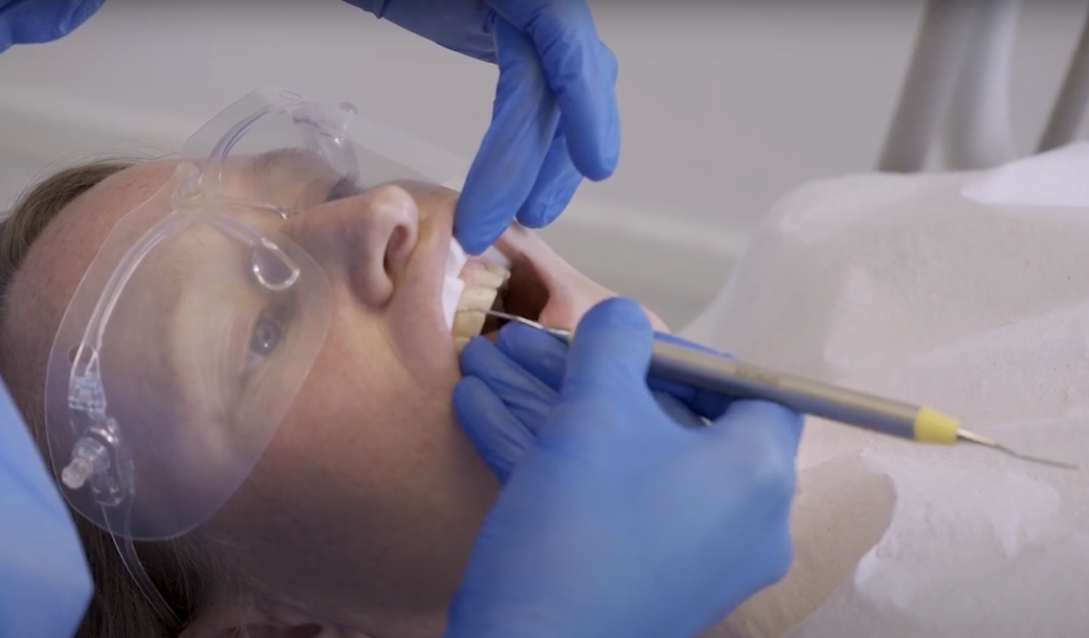 Anwendung der 5/6 Gracey Kürette 